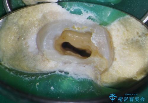 【根管治療・オールセラミッククラウン】何もしなくても歯が痛い 咬むと更に痛いの治療中