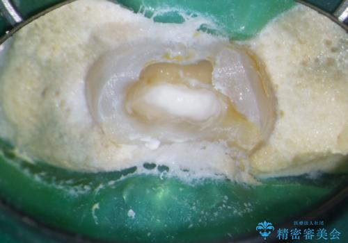 【根管治療・オールセラミッククラウン】何もしなくても歯が痛い 咬むと更に痛いの治療中