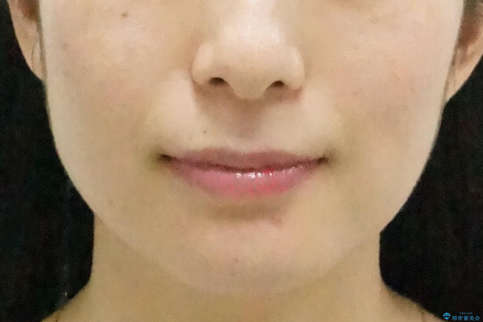 前歯のがたつき、八重歯 インビザラインで抜歯矯正の治療後(顔貌)