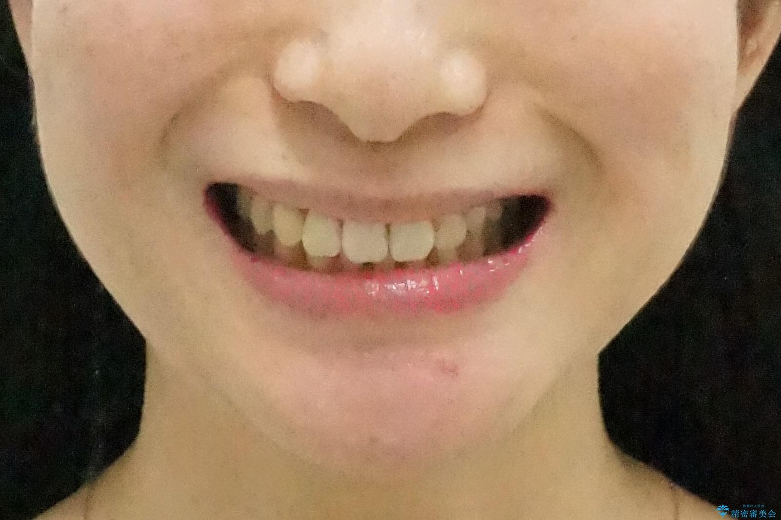 前歯のがたつき、八重歯 インビザラインで抜歯矯正の治療後(顔貌)