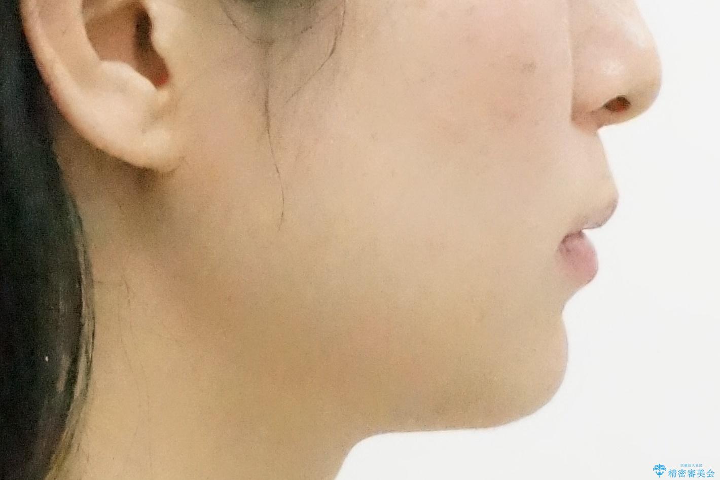 前歯のがたつき、八重歯 インビザラインで抜歯矯正の治療後(顔貌)