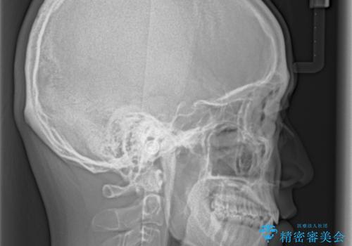 隙間とデコボコを治したい ワイヤー装置による矯正治療の治療前