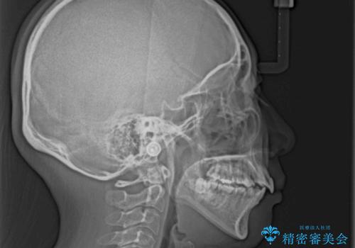 八重歯と出っ歯を治したい ワイヤー装置での抜歯矯正の治療前