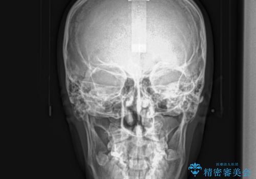 ガタガタの歯並び、八重歯をなおしたい、骨格性下顎前突 カモフラージュ矯正の治療前