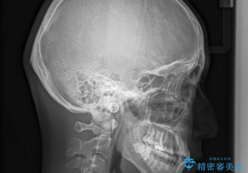 ガタガタの歯並び、八重歯をなおしたい、骨格性下顎前突 カモフラージュ矯正の治療前