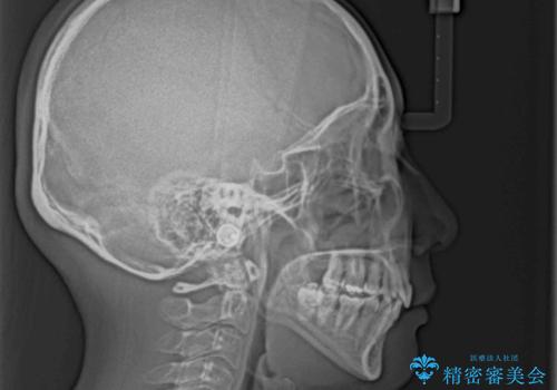 八重歯と出っ歯を治したい ワイヤー装置での抜歯矯正の治療後