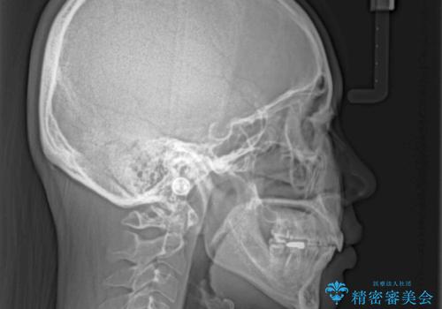 抜歯矯正で唇を閉じやすく ワイヤー矯正の治療後