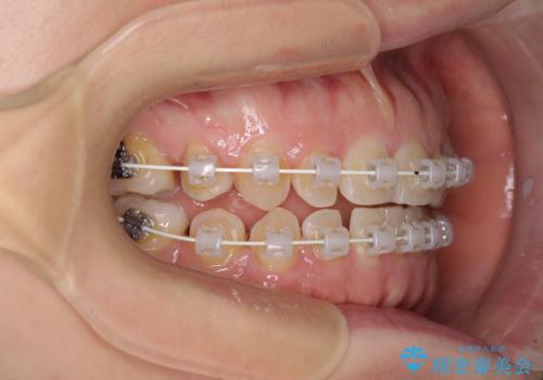 隙間の空いた歯列とボロボロの乳歯　インプラント治療と矯正治療の治療中