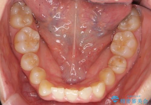 前歯のがたつき、八重歯 インビザラインで抜歯矯正の治療前