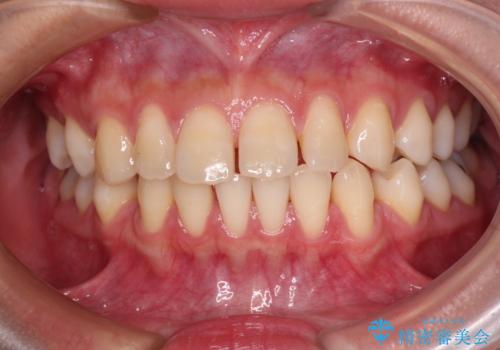 隙間の多い歯並びをインビザラインで矯正治療の症例 治療前