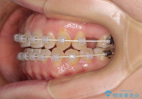 隙間の空いた歯列とボロボロの乳歯 インプラント治療と矯正治療の治療中