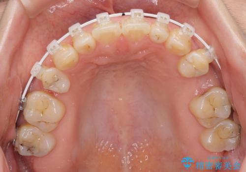 隙間の空いた歯列とボロボロの乳歯　インプラント治療と矯正治療の治療中