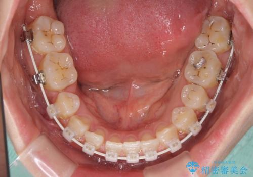 隙間の空いた歯列とボロボロの乳歯 インプラント治療と矯正治療の治療中