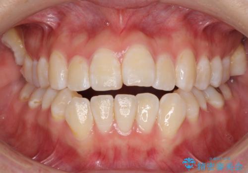 外に飛び出して磨きにくい奥歯と上下前歯の隙間　インビザラインによる矯正治療の症例 治療前