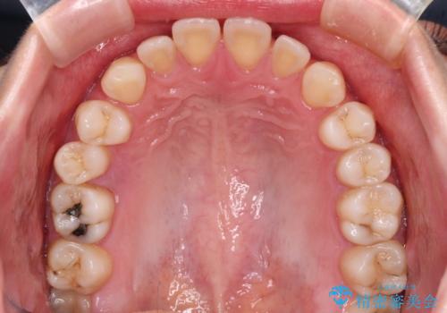 隙間の多い歯並びをインビザラインで矯正治療の治療前