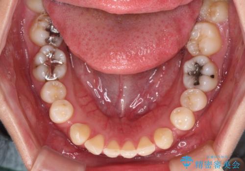 隙間の多い歯並びをインビザラインで矯正治療の治療前