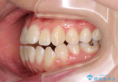 外に飛び出して磨きにくい奥歯と上下前歯の隙間　インビザラインによる矯正治療の治療前