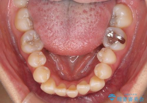 外に飛び出して磨きにくい奥歯と上下前歯の隙間　インビザラインによる矯正治療の治療前