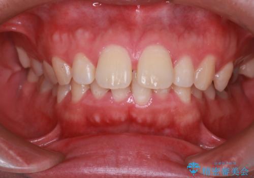 【前突症例】前歯を下げたいの症例 治療前