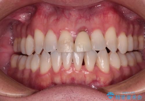 他院で矯正治療中 変色した前歯のオールセラミッククラウン治療の治療前