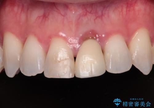 他院で矯正治療中 変色した前歯のオールセラミッククラウン治療の症例 治療前