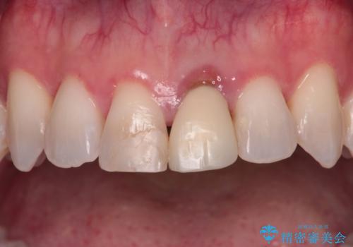 他院で矯正治療中 変色した前歯のオールセラミッククラウン治療の治療前