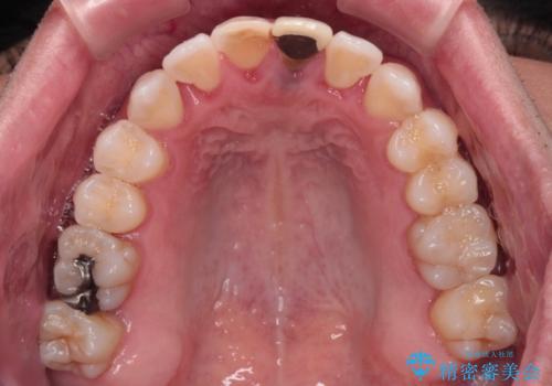 他院で矯正治療中 変色した前歯のオールセラミッククラウン治療の治療前