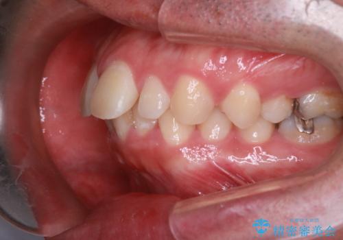 【前突症例】前歯を下げたいの治療前
