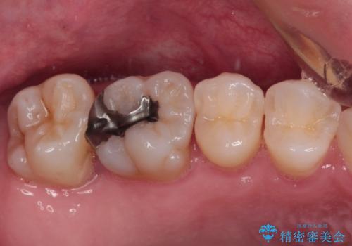 他院で矯正治療中 変色した前歯のオールセラミッククラウン治療の治療前