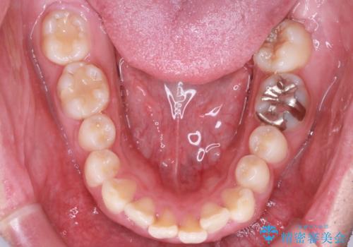 【前突症例】前歯を下げたいの治療前