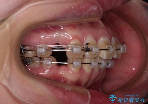 抜歯矯正で唇を閉じやすく ワイヤー矯正の治療中