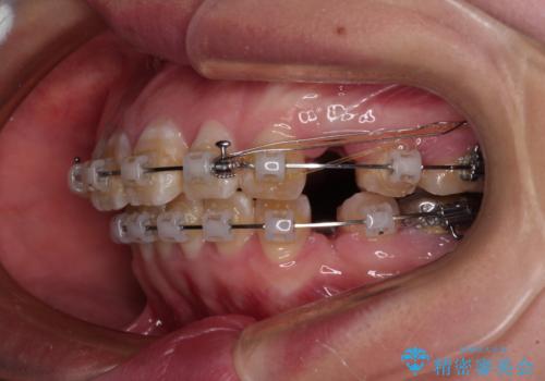 抜歯矯正で唇を閉じやすく ワイヤー矯正の治療中