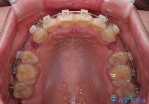 抜歯矯正で唇を閉じやすく ワイヤー矯正の治療中