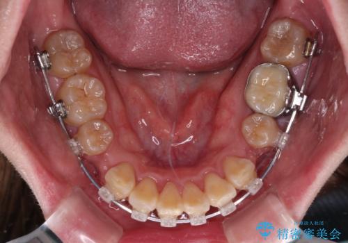 抜歯矯正で唇を閉じやすく ワイヤー矯正の治療中