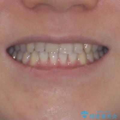 隙間とデコボコを治したい ワイヤー装置による矯正治療の治療後(顔貌)