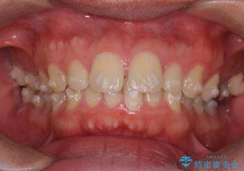 【前突症例】前歯を下げたいの治療中