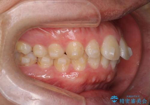 【前突症例】前歯を下げたいの治療中