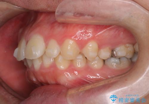 【前突症例】前歯を下げたいの治療中