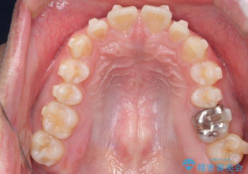 【前突症例】前歯を下げたいの治療中