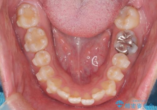 【前突症例】前歯を下げたいの治療中