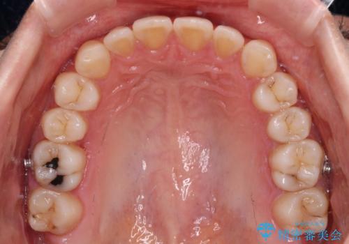隙間の多い歯並びをインビザラインで矯正治療の治療中