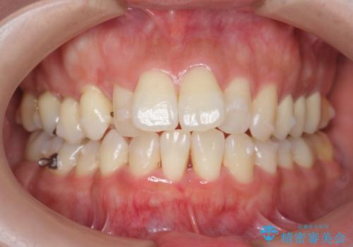 職業柄ワイヤー矯正ができない、マウスピース矯正で行う八重歯抜歯症例の治療中