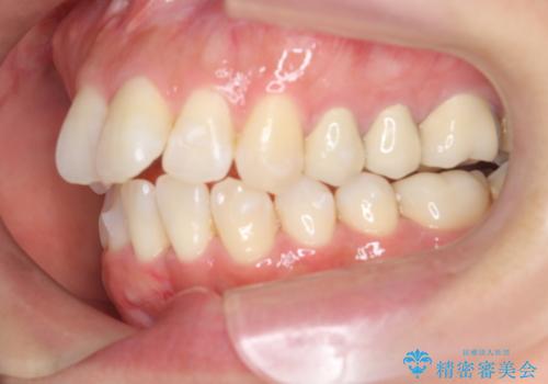 職業柄ワイヤー矯正ができない、マウスピース矯正で行う八重歯抜歯症例の治療中