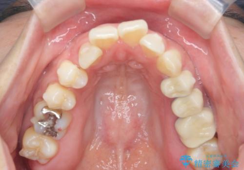 職業柄ワイヤー矯正ができない、マウスピース矯正で行う八重歯抜歯症例の治療中