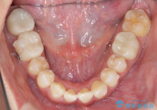 職業柄ワイヤー矯正ができない、マウスピース矯正で行う八重歯抜歯症例の治療中