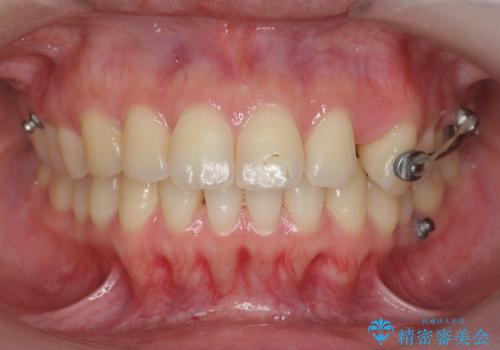 カリエール・マイクロインプラントを併用した歯の突出を改善する大きな遠心移動の治療中