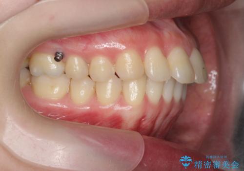 カリエール・マイクロインプラントを併用した歯の突出を改善する大きな遠心移動の治療中