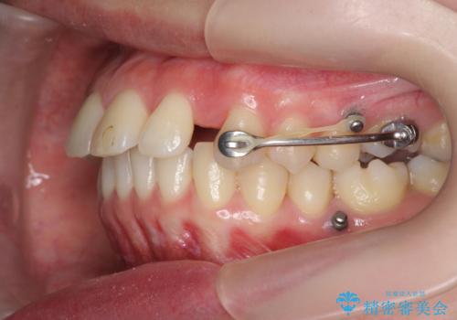 カリエール・マイクロインプラントを併用した歯の突出を改善する大きな遠心移動の治療中