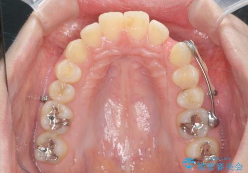 カリエール・マイクロインプラントを併用した歯の突出を改善する大きな遠心移動の治療中