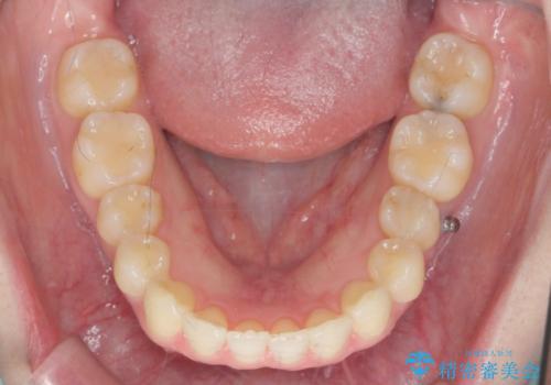カリエール・マイクロインプラントを併用した歯の突出を改善する大きな遠心移動の治療中